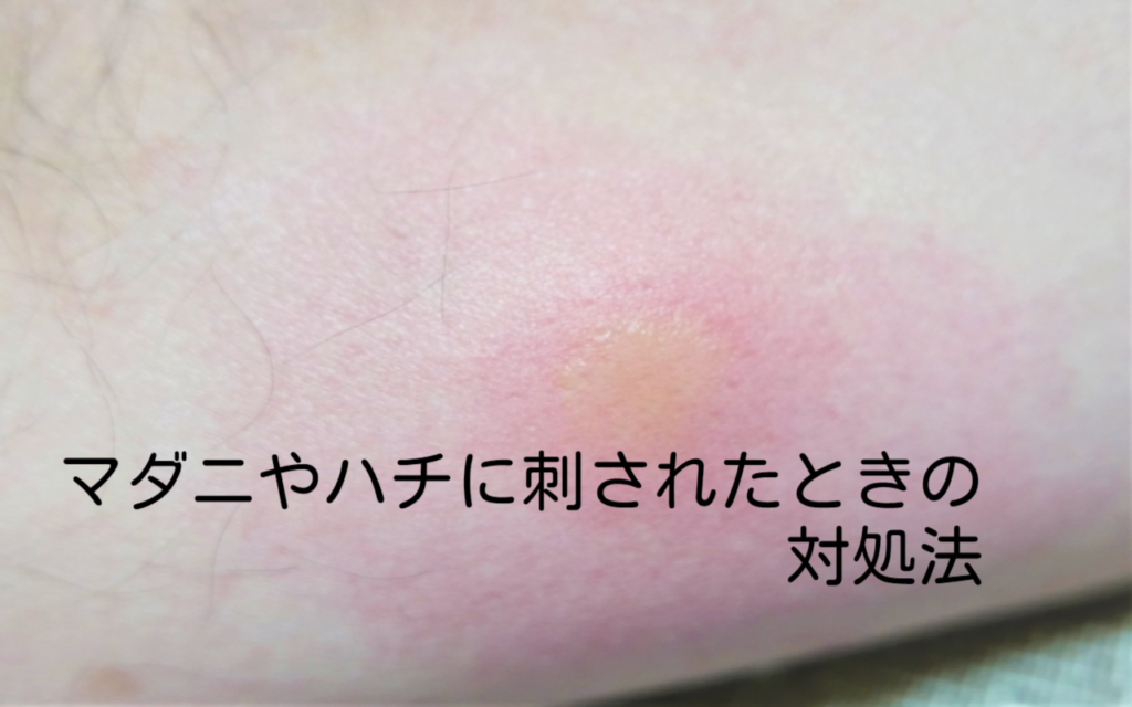 マダニやハチに刺されたときの対処法 | ぴのの薬局あれこれ
